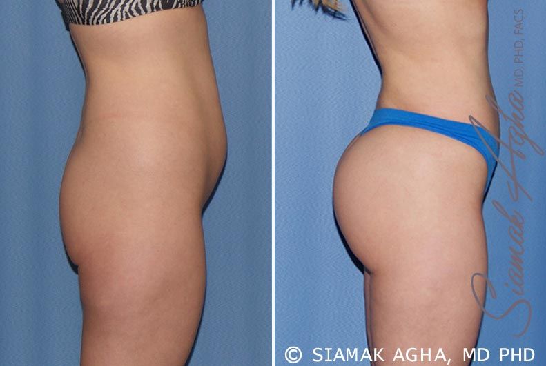 Brazilian Butt Lift Before & After