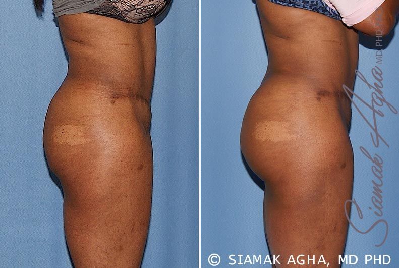 Brazilian Butt Lift Before & After