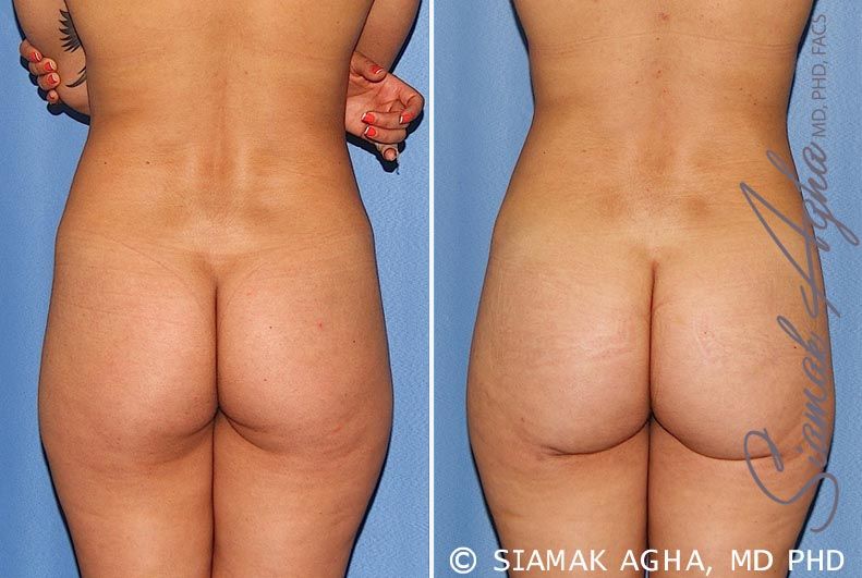 Brazilian Butt Lift Before & After