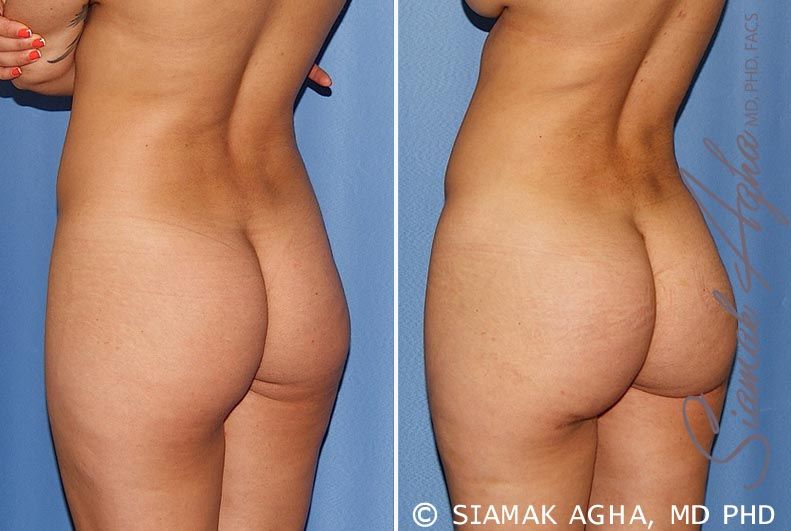 Brazilian Butt Lift Before & After