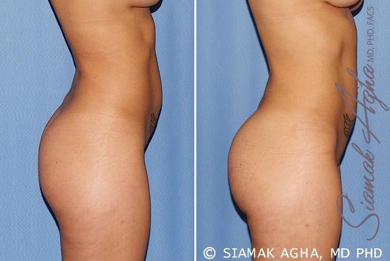 Brazilian Butt Lift Before & After