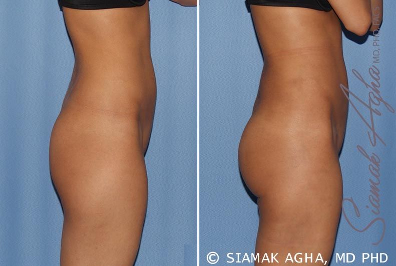 Brazilian Butt Lift Before & After