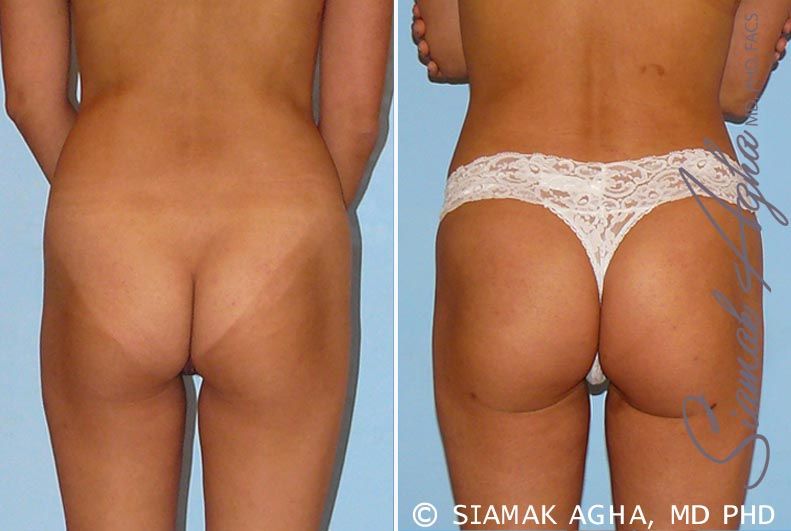 Brazilian Butt Lift Before & After