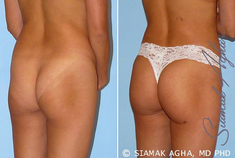 Brazilian Butt Lift Before & After