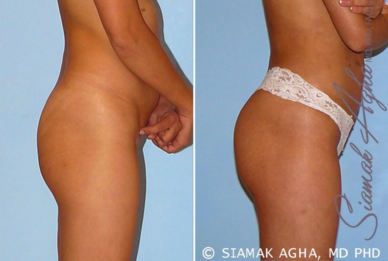 Brazilian Butt Lift Before & After