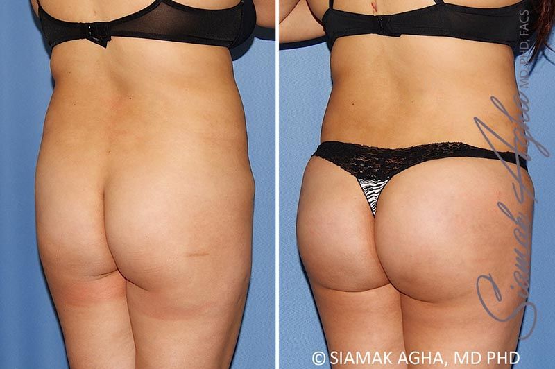 Brazilian Butt Lift Before & After