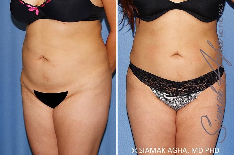 Brazilian Butt Lift Before & After