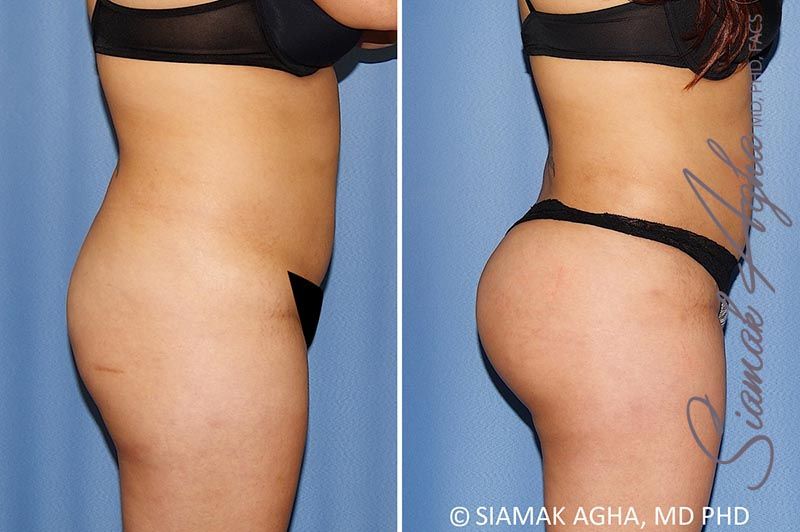 Brazilian Butt Lift Before & After