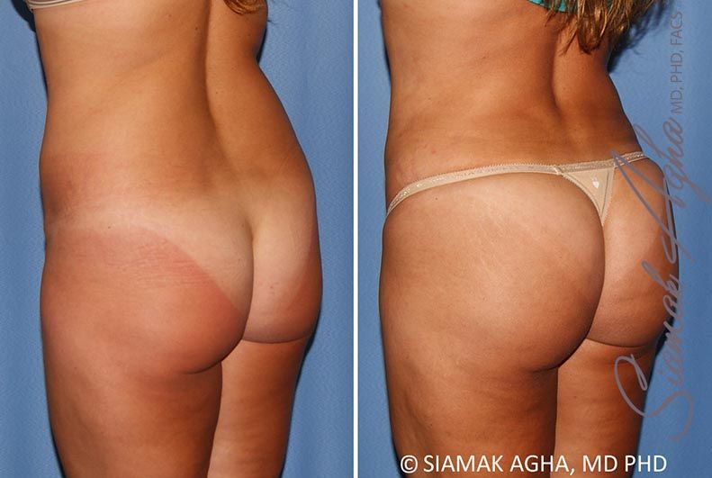 Brazilian Butt Lift Before & After