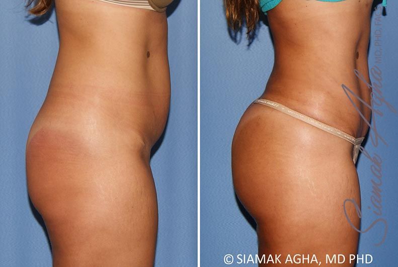 Brazilian Butt Lift Before & After