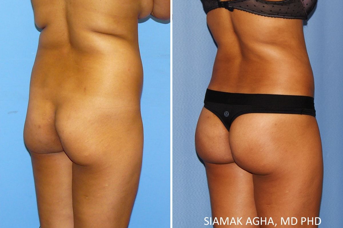 Brazilian Butt Lift Before & After