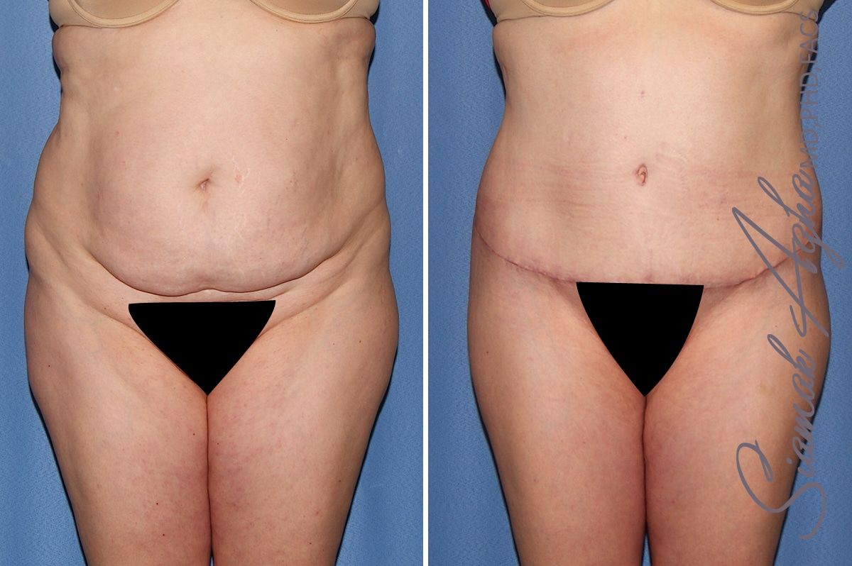 Brazilian Butt Lift Before & After