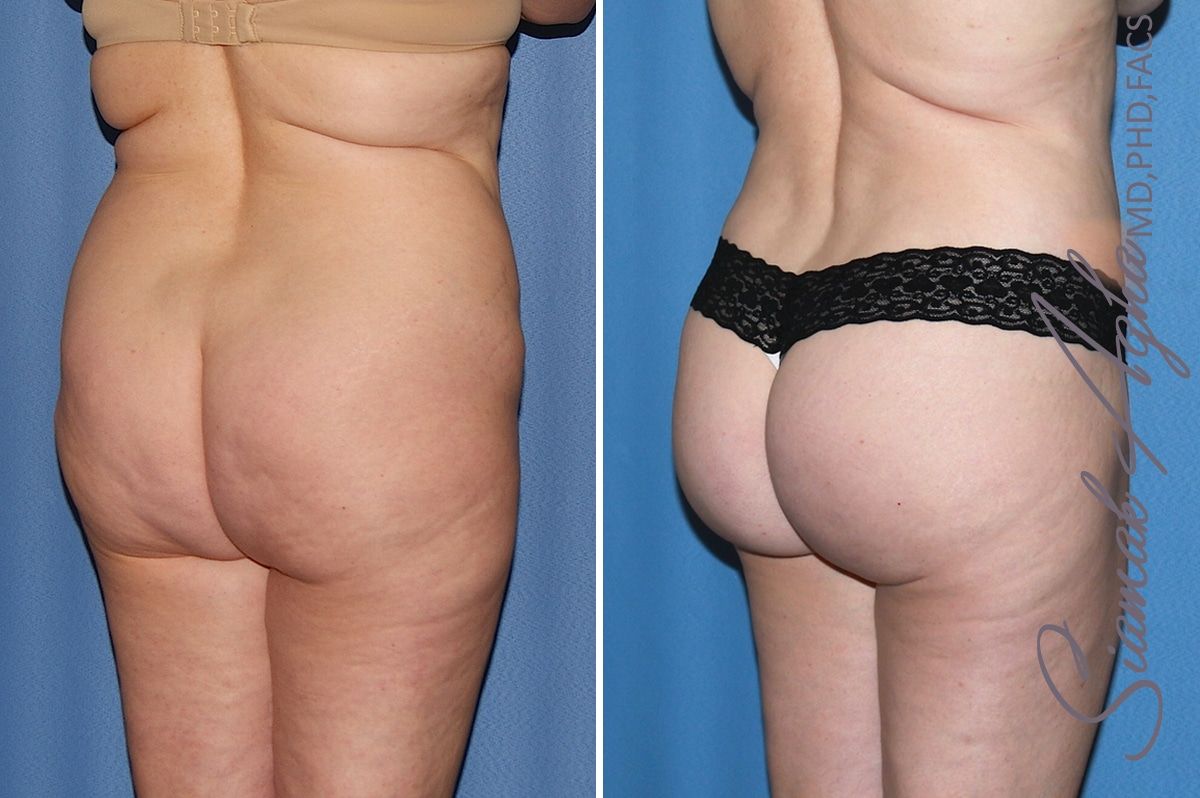 Brazilian Butt Lift Before & After
