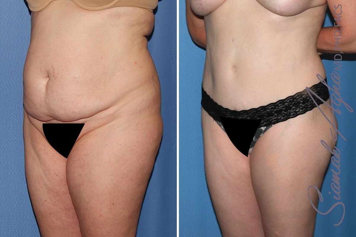 Brazilian Butt Lift Before & After