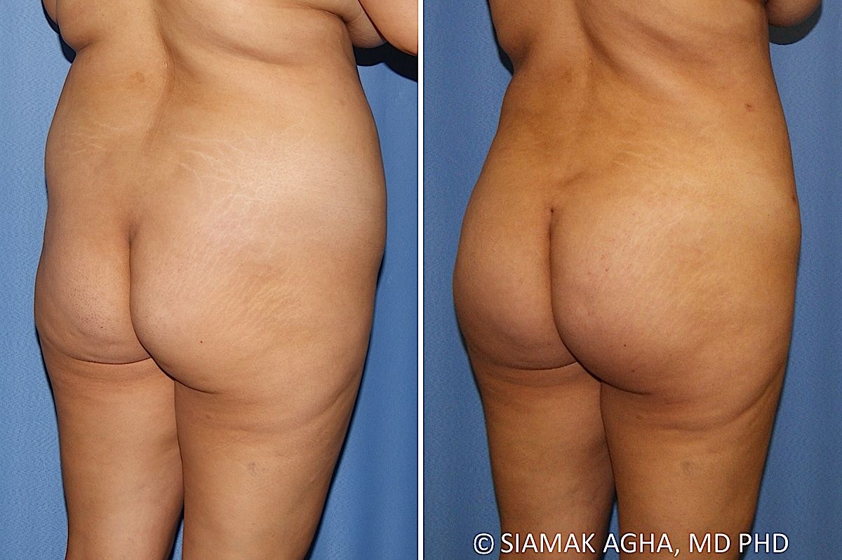 Brazilian Butt Lift Before & After