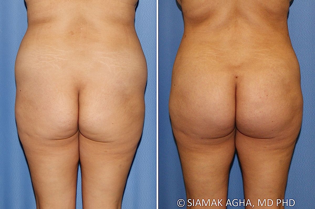 Brazilian Butt Lift Before & After