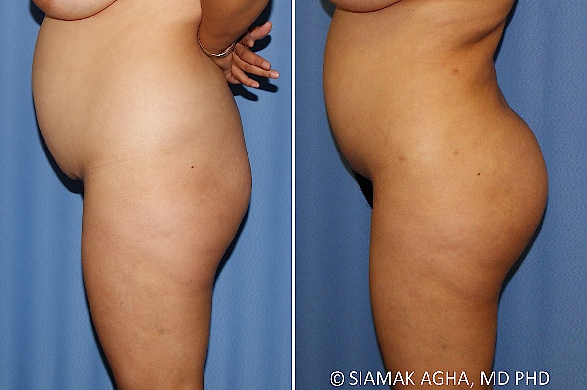 Brazilian Butt Lift Before & After