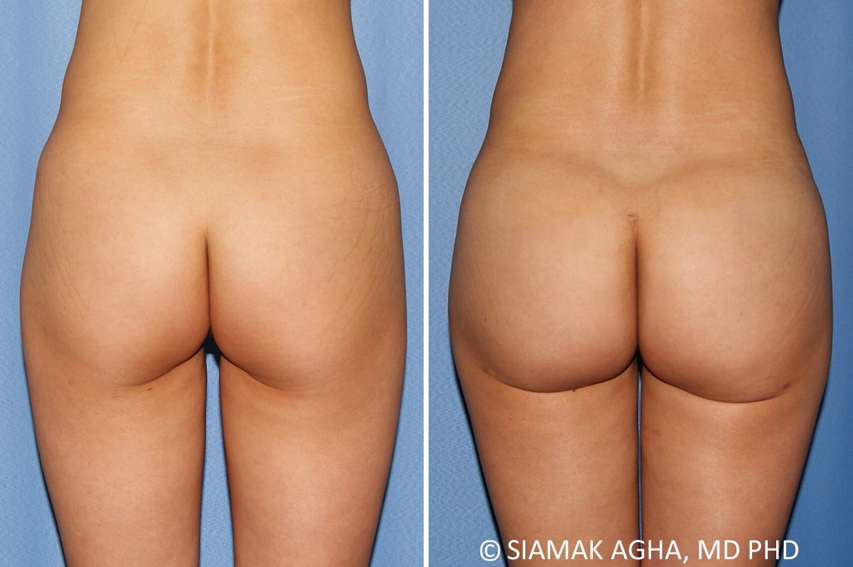 Brazilian Butt Lift Before & After