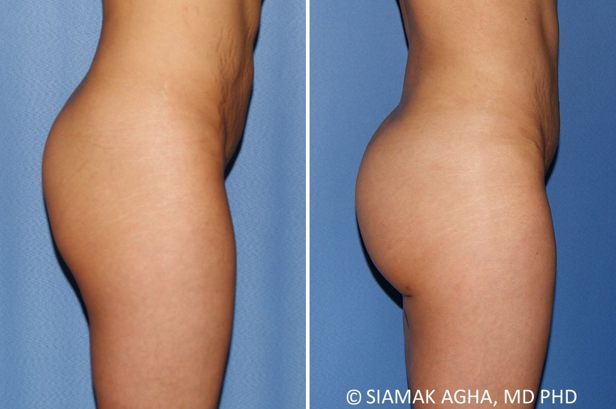 Brazilian Butt Lift Before & After