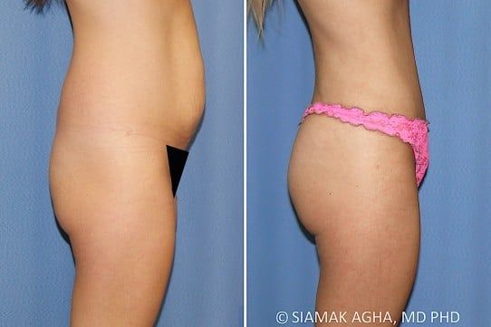 Brazilian Butt Lift Before & After