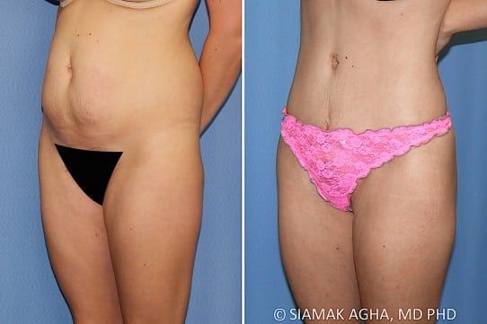Brazilian Butt Lift Before & After