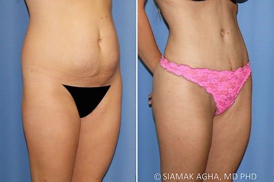 Brazilian Butt Lift Before & After