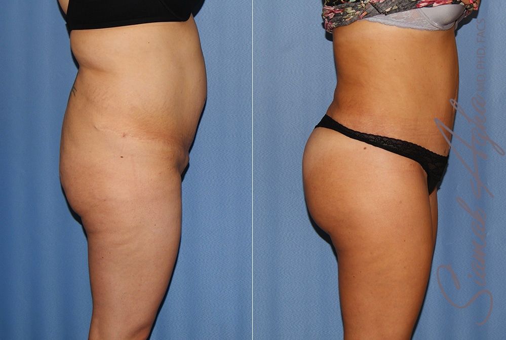 Brazilian Butt Lift Before & After
