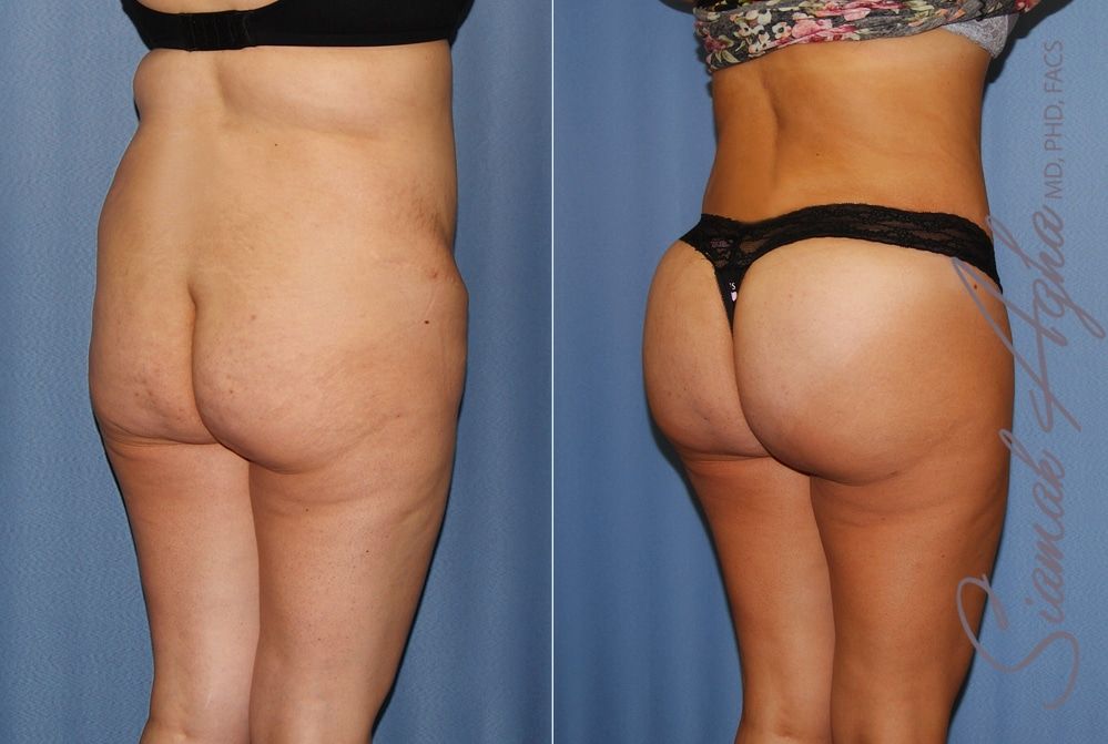 Brazilian Butt Lift Before & After