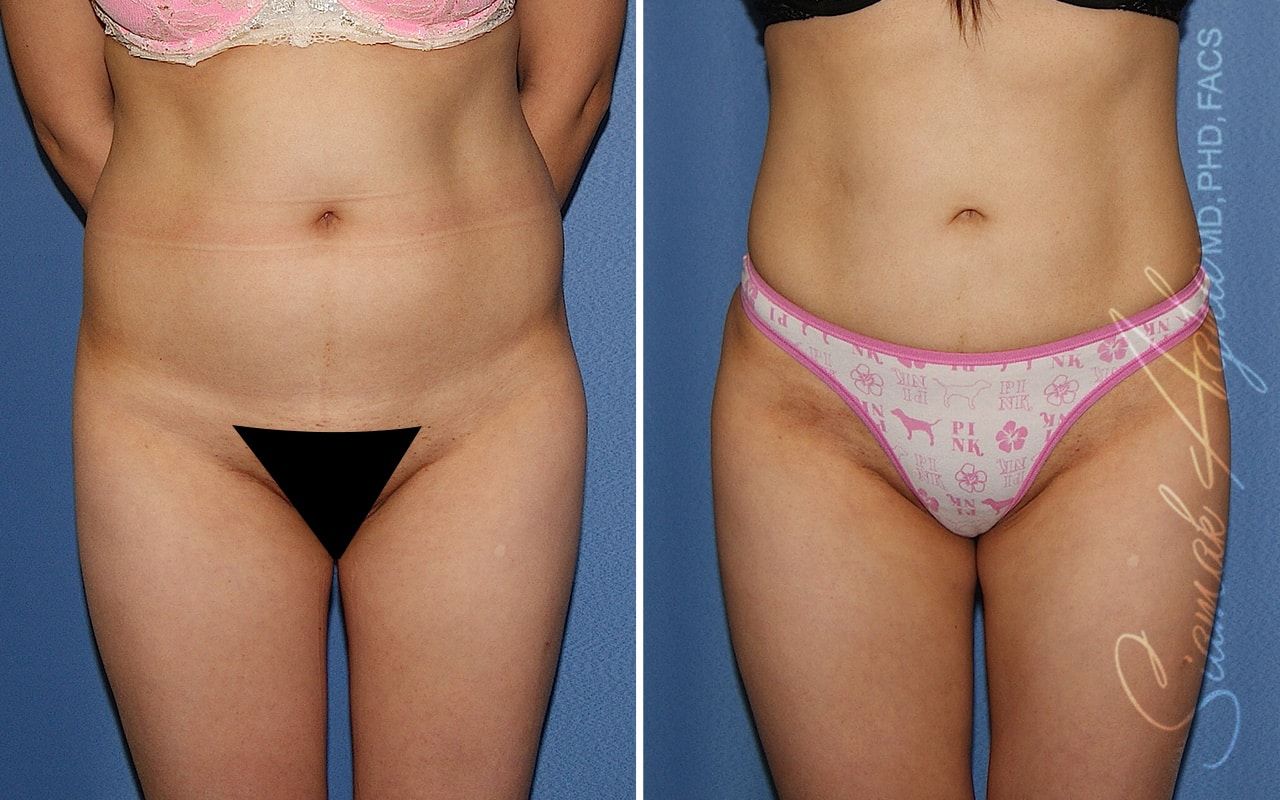 Brazilian Butt Lift Before & After