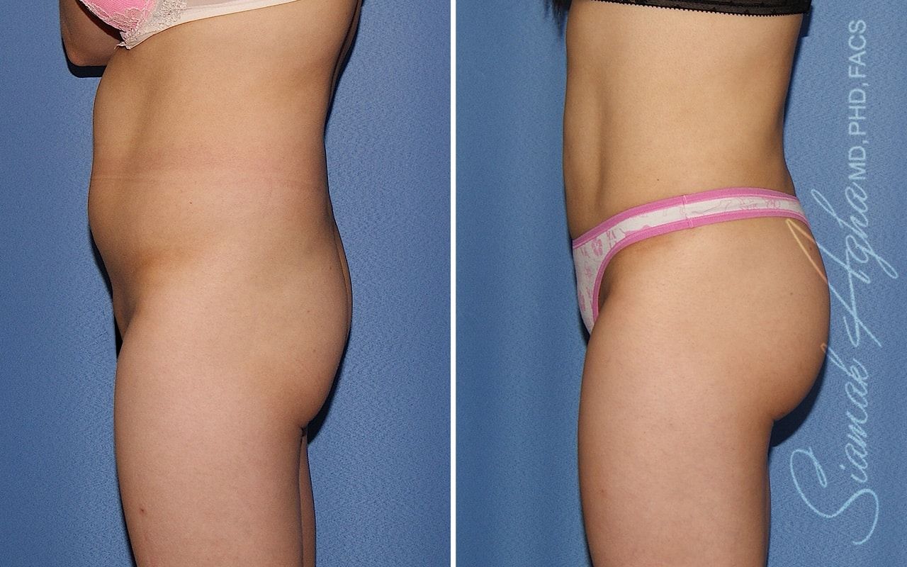 Brazilian Butt Lift Before & After
