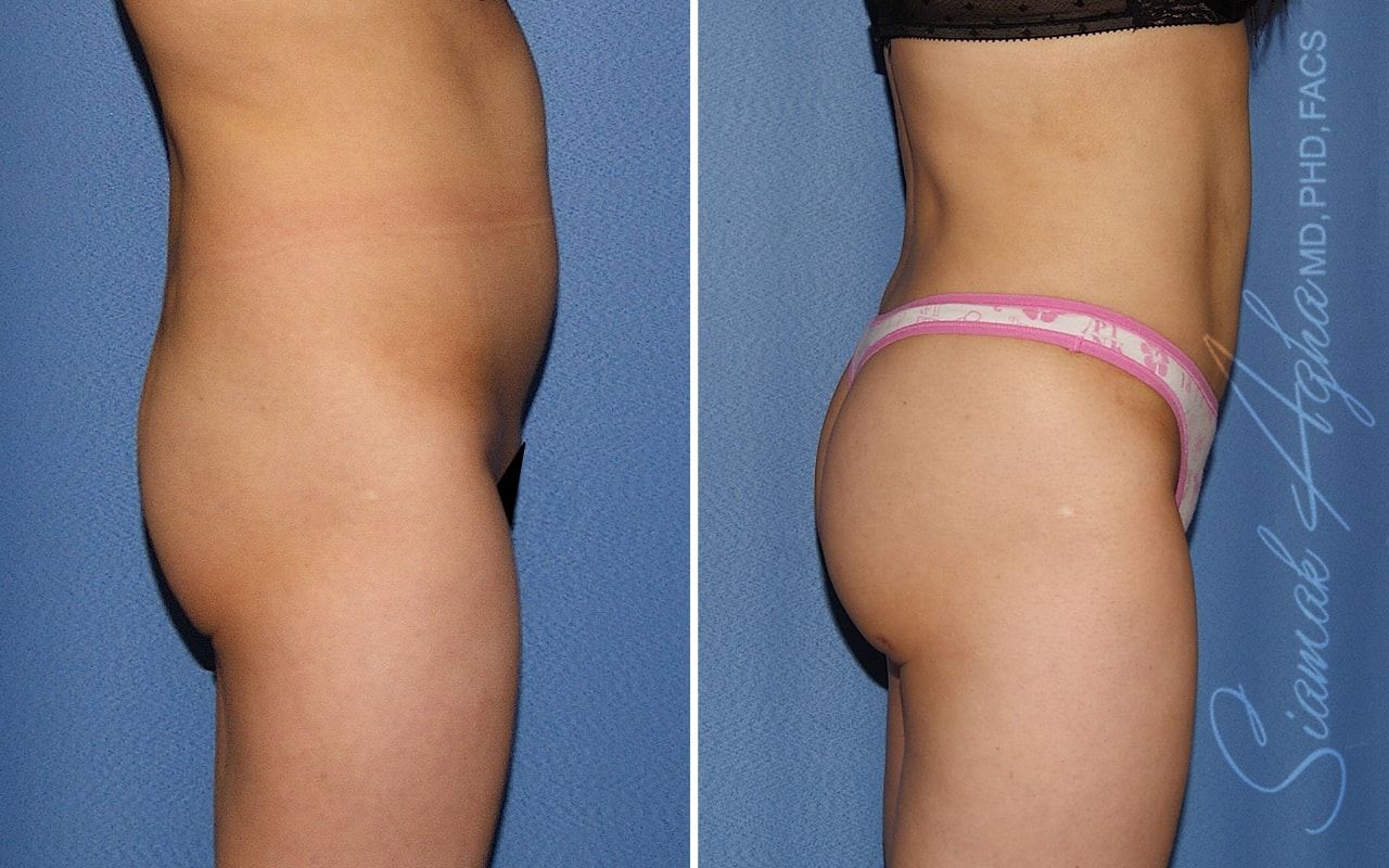 Brazilian Butt Lift Before & After