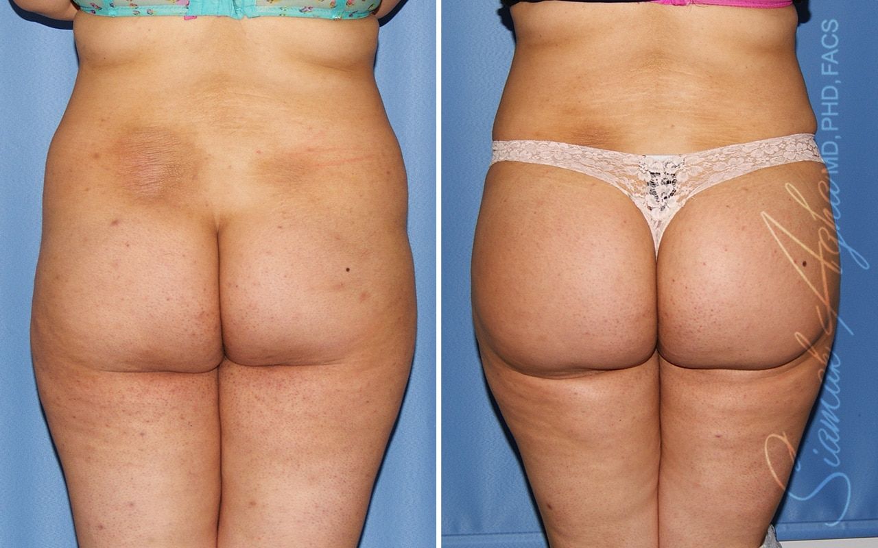 Brazilian Butt Lift Before & After