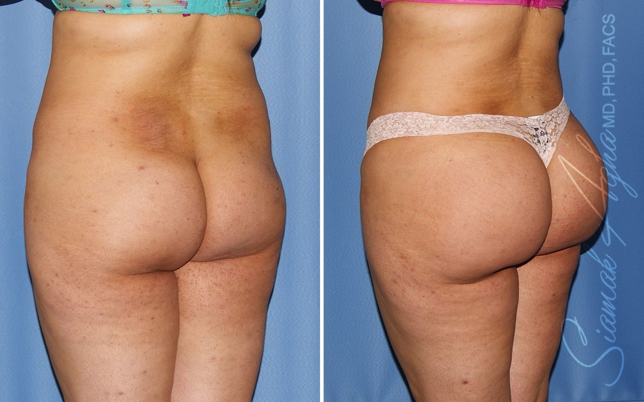 Brazilian Butt Lift Before & After