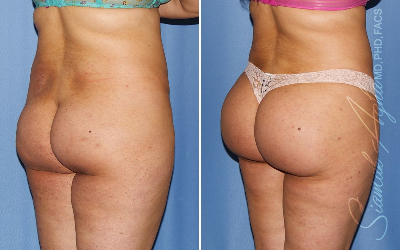 Brazilian Butt Lift Before & After