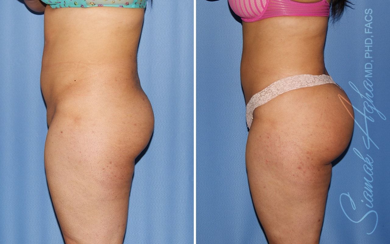 Brazilian Butt Lift Before & After