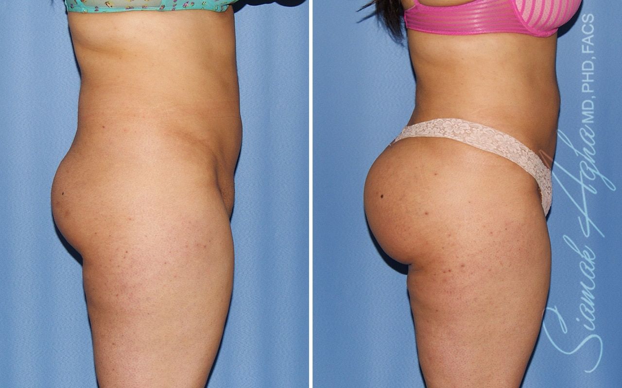 Brazilian Butt Lift Before & After