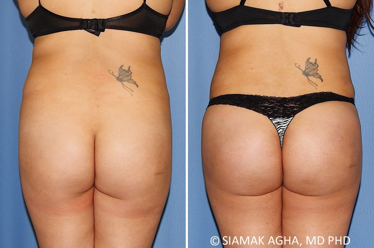 Brazilian Butt Lift Before & After