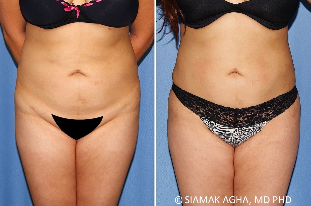 Brazilian Butt Lift Before & After