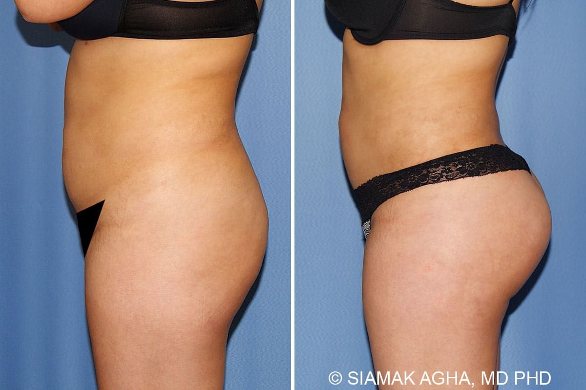 Brazilian Butt Lift Before & After