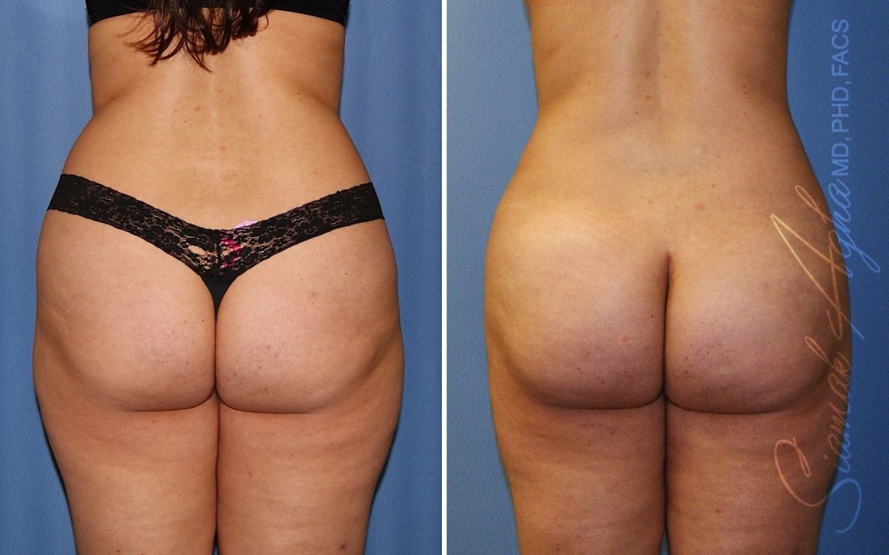 Brazilian Butt Lift Before & After