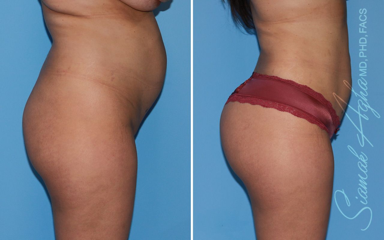 Brazilian Butt Lift Before & After