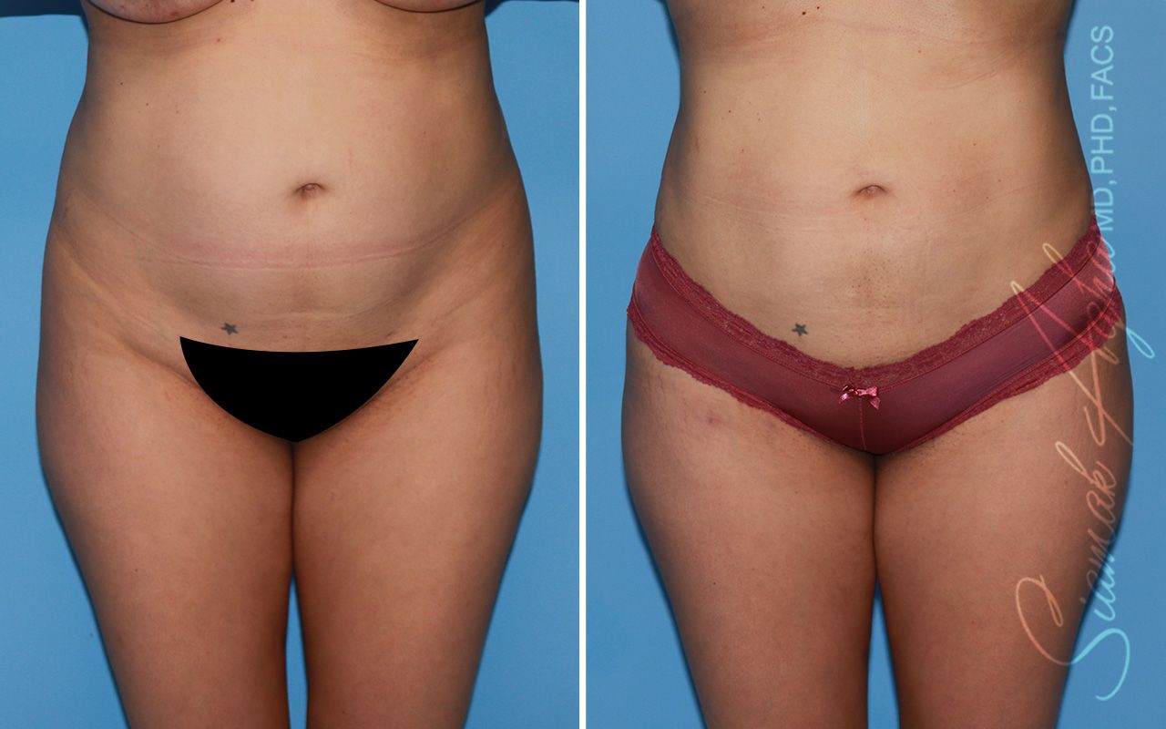 Brazilian Butt Lift Before & After