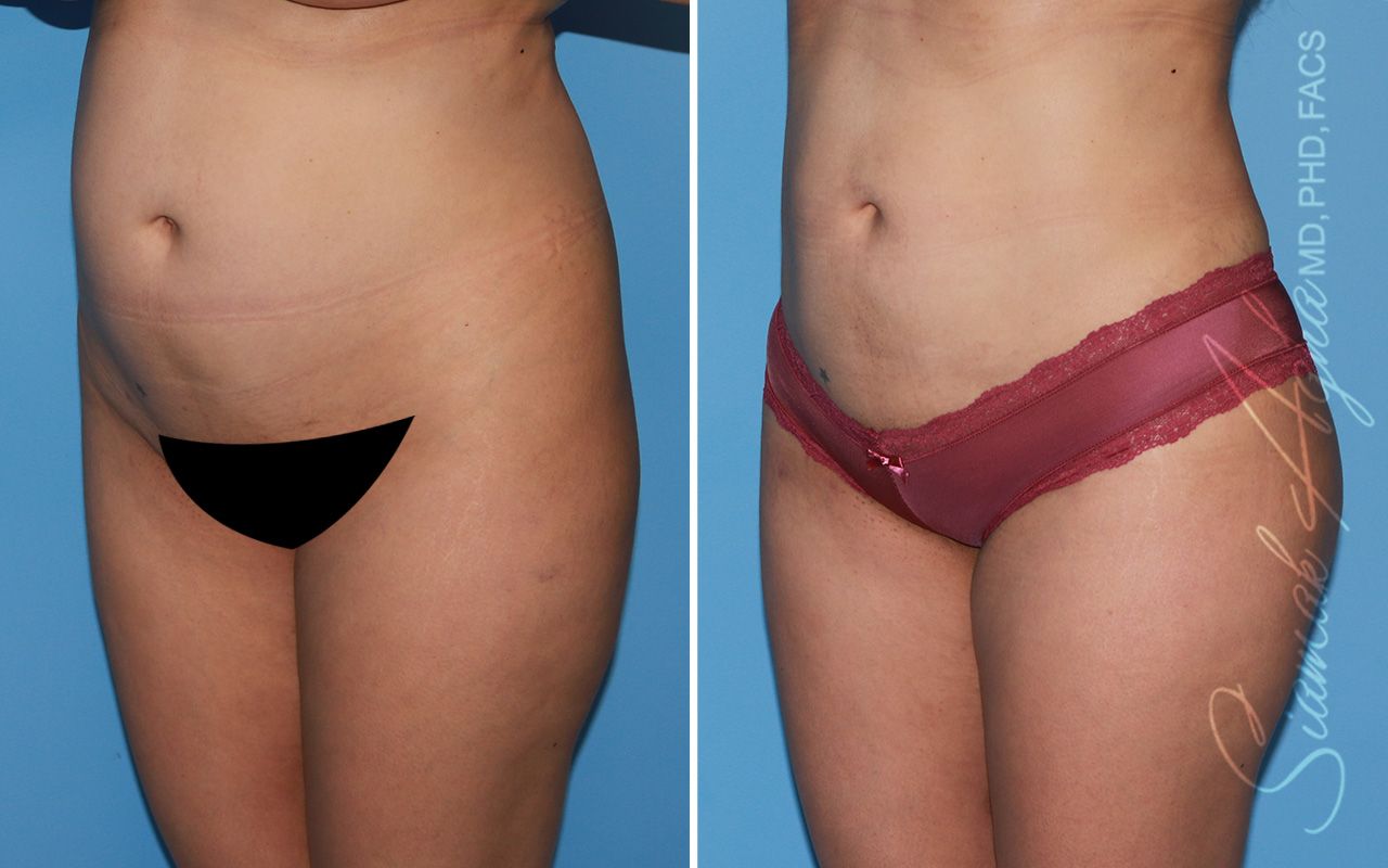 Brazilian Butt Lift Before & After