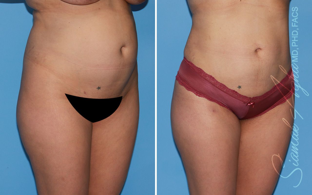 Brazilian Butt Lift Before & After