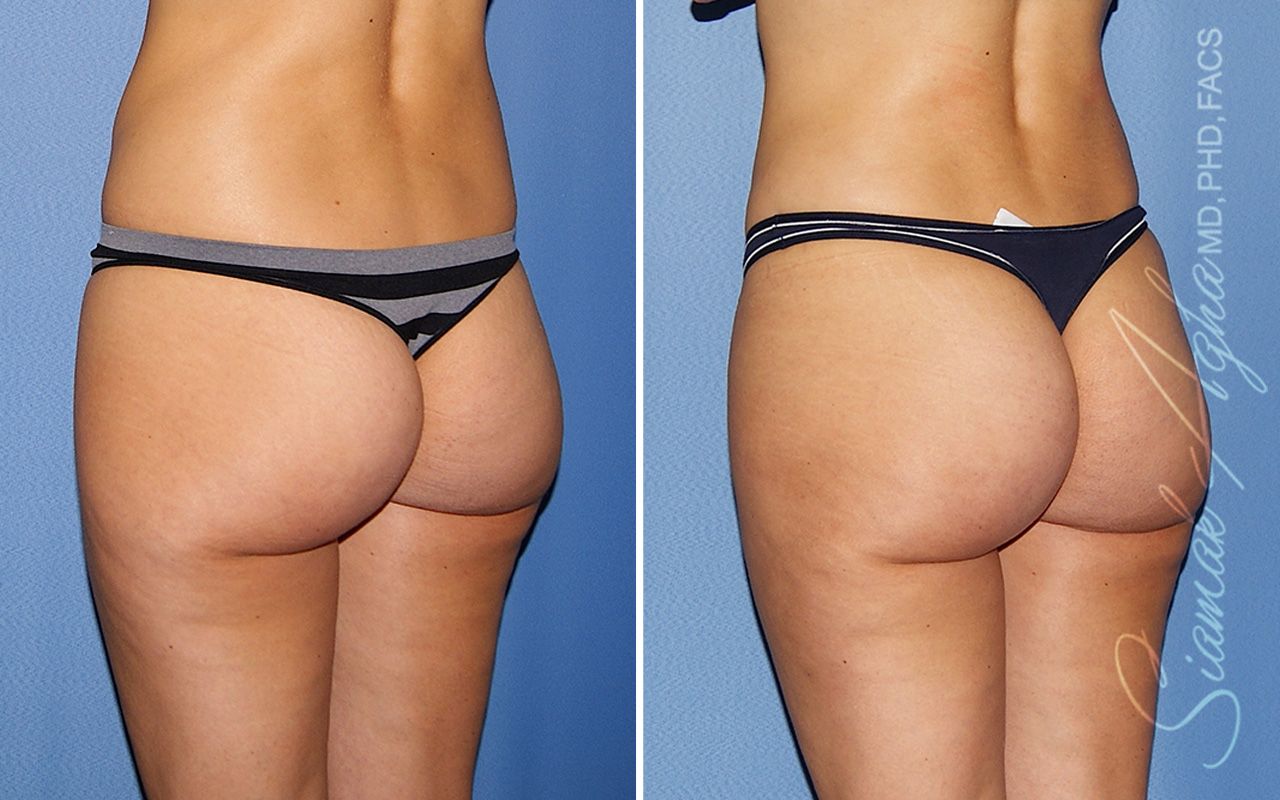 Brazilian Butt Lift Before & After