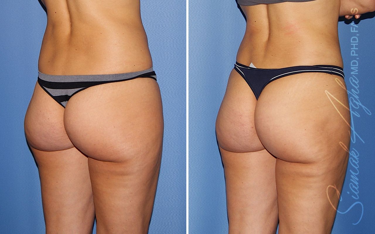 Brazilian Butt Lift Before & After