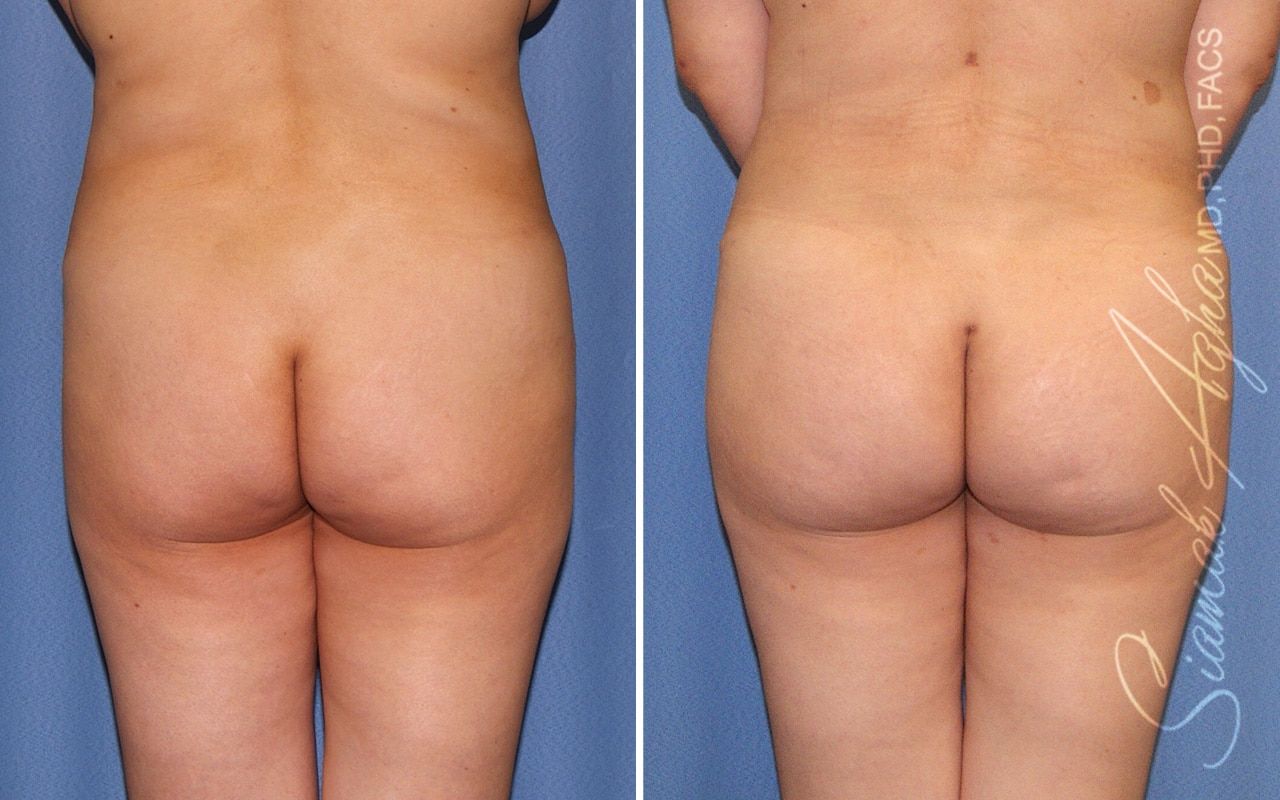 Brazilian Butt Lift Before & After