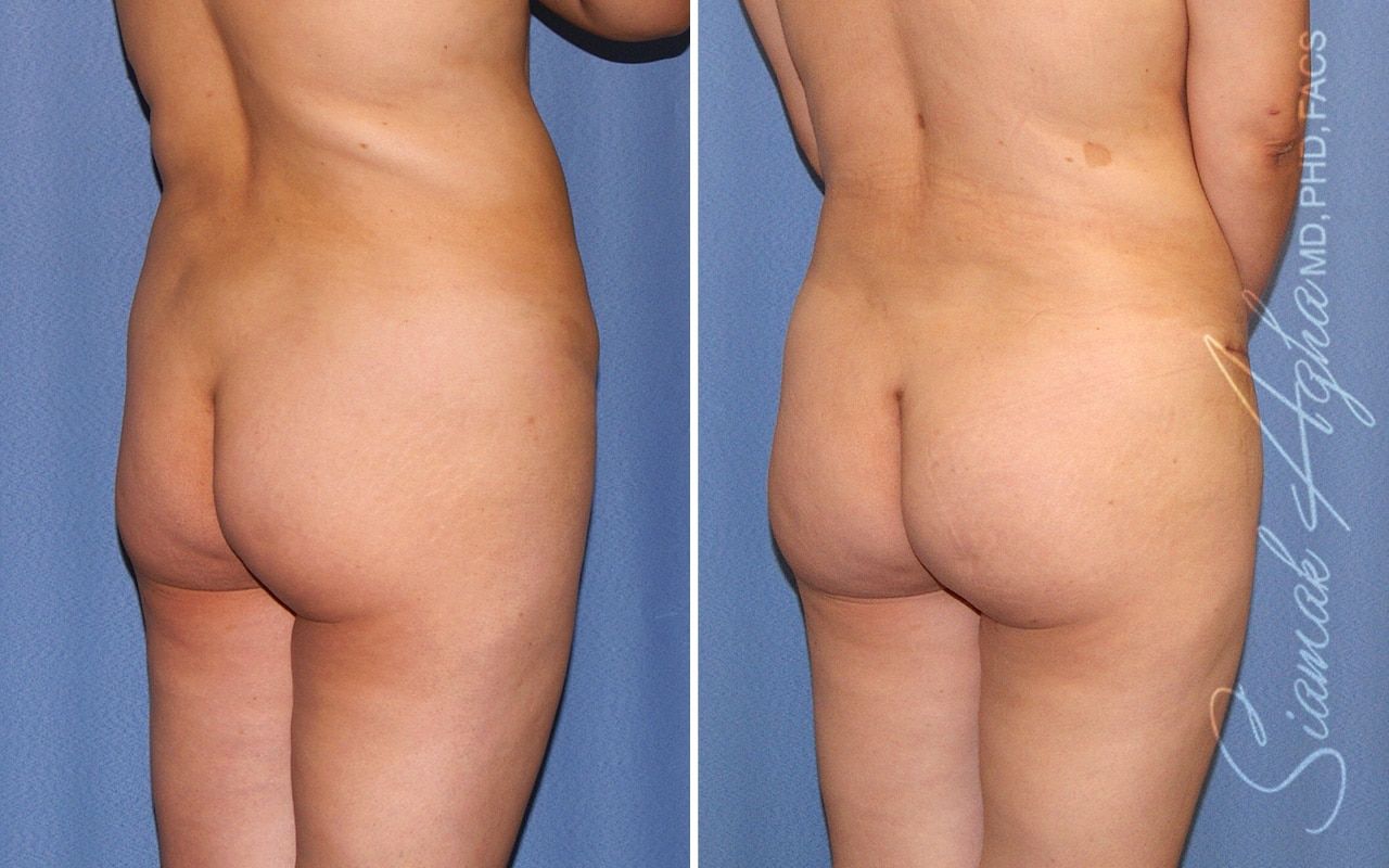 Brazilian Butt Lift Before & After