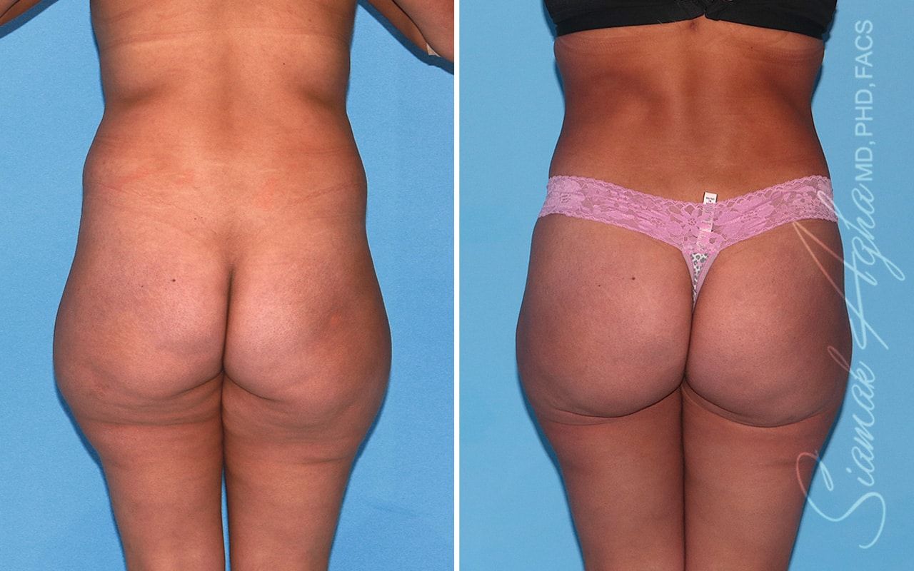 Brazilian Butt Lift Before & After