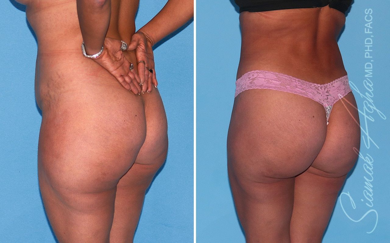 Brazilian Butt Lift Before & After